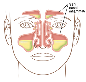 Illustrazione di un volto con seni nasali infiammati.