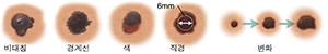 비대칭 형태의 점. 경계선이 불규칙적이고 흐릿한 점. 짙은 색과 밝은 색의 반점들로 이루어진 점. 직경 6mm의 점. 시간이 지나면서 달라지는 점 3개.
